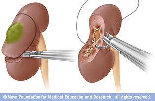 removal of adrenal glands